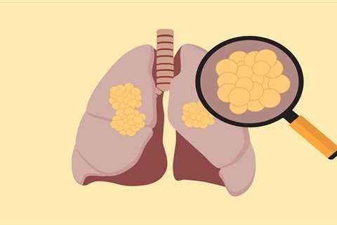 Racial Disparities in Lung Cancer Start With Research