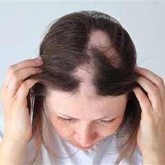 Adolescents with alopecia respond just as well as adults to ritlecitinib treatment