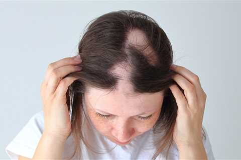Adolescents with alopecia respond just as well as adults to ritlecitinib treatment