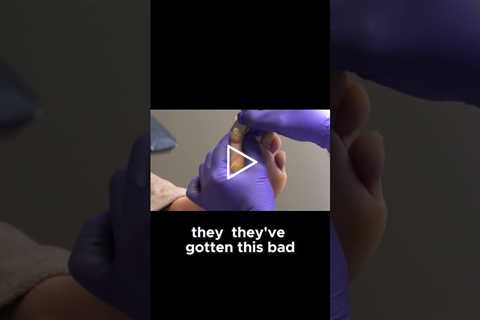 Genetic Condition Causes Thick Calluses  #GeneticCondition #calluses  #healthtalks