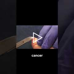 Dealing with Skin Cancer on My Foot #SkinCancerAwareness #FootHealth #MedicalAppointments