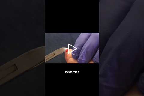 Dealing with Skin Cancer on My Foot #SkinCancerAwareness #FootHealth #MedicalAppointments