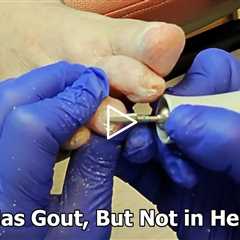 She Has Gout, But Not in Her Foot