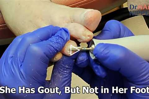 She Has Gout, But Not in Her Foot