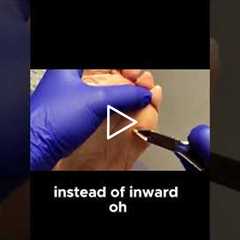 Watch How a Keratotic Horn Is Painlessly Trim #FootCare #SkinHealth  #PainFreeTreatment