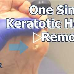 One Single Keratotic Horn Removal | Dr. Nail Nipper #foothealth #keratotichorn #callusremoval