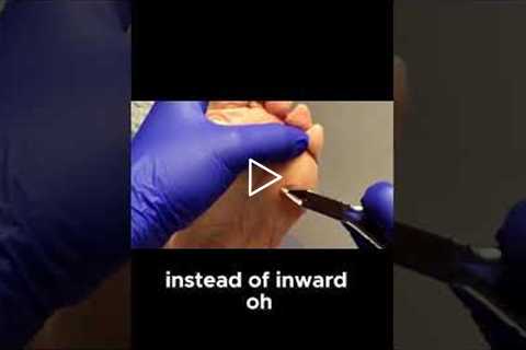 Watch How a Keratotic Horn Is Painlessly Trim #FootCare #SkinHealth  #PainFreeTreatment