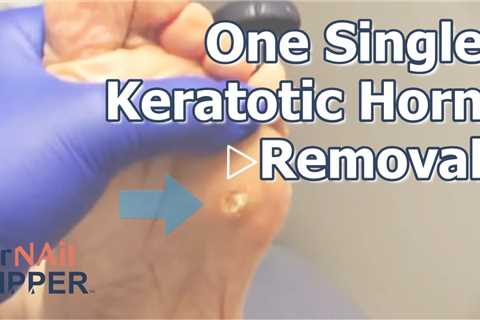 One Single Keratotic Horn Removal | Dr. Nail Nipper #foothealth #keratotichorn #callusremoval
