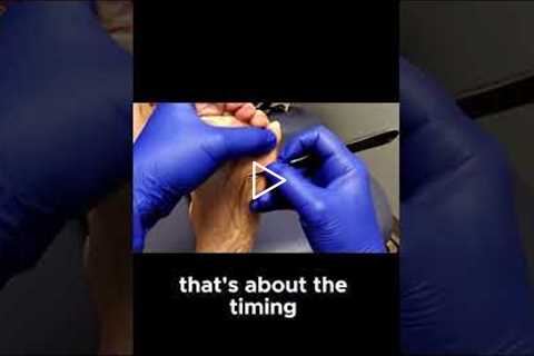 How Regular Trimming Helps Manage Painful Calluses Effectively #FootCareTips #CallusRelief