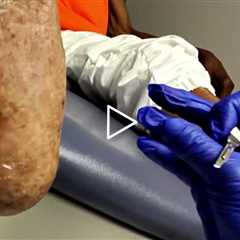 Painful Foot Core Removed | No Fat Pad Protection 😣👣