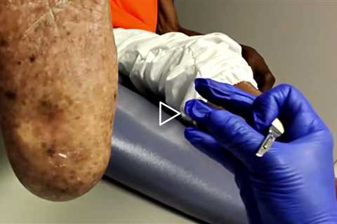 Painful Foot Core Removed | No Fat Pad Protection 😣👣