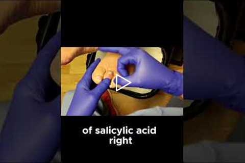 Why Medicated Corn Pads Can Make Foot Pain Worse