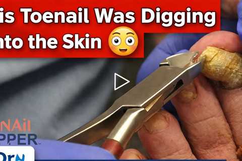This Toenail Was Digging Into the Skin 😳 | Painful Foot Relief