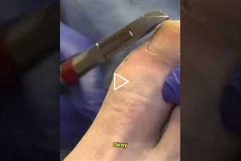 How Podiatrists Get Toenails Perfectly Smooth #nailcare #satisfying