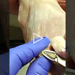 How a Podiatrist Removes Deeply Ingrown Toenails