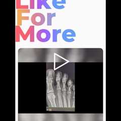 Understanding X-Rays: Decoding the Foot Condition