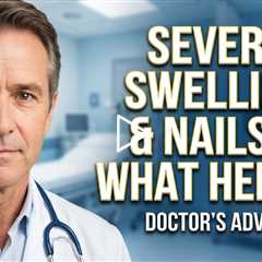 Severe Leg Swelling, Lymphedema & Thick Nails – What Actually Helps?