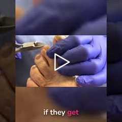 Fungal Infection Myths BUSTED! It's NOT Systemic