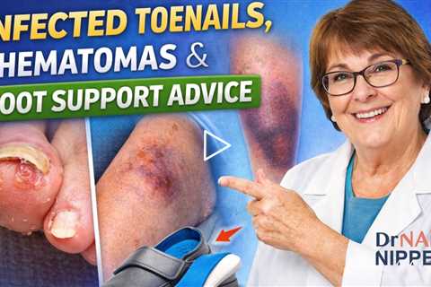 Infected Toenails, Hematomas & Foot Support Advice | Dr Nail Nipper (Video from 2022)