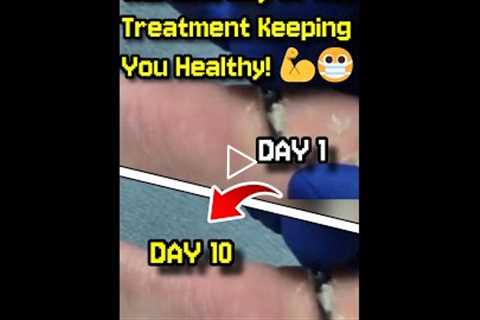 The Journey of Wart Treatment Keeping You Healthy! 💪😷