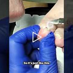 Doctor vs loose toenail (no, it won’t hurt)