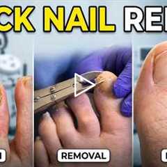 FEET-ure Friday |  Thick Toenail Caused a Hidden Wound (Diabetic Foot Warning)