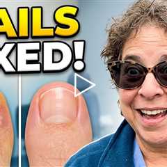 Thick Overgrown Nails After 12 Months