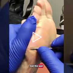 How to treat calluses and corns