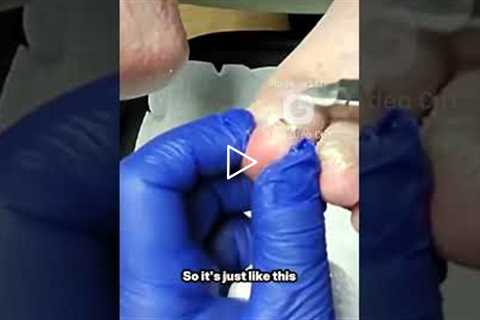 Doctor vs loose toenail (no, it won’t hurt)