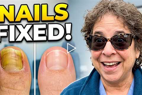 Thick Overgrown Nails After 12 Months