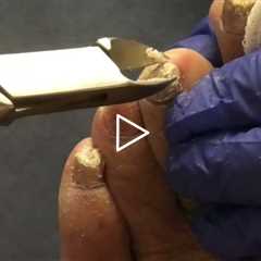 Really Thick Toenails