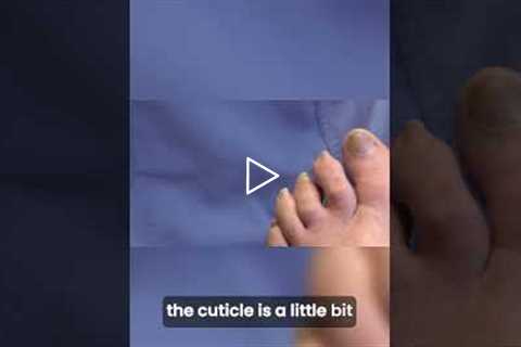 Fungal Treatment Success Nail Growth Update 🌱