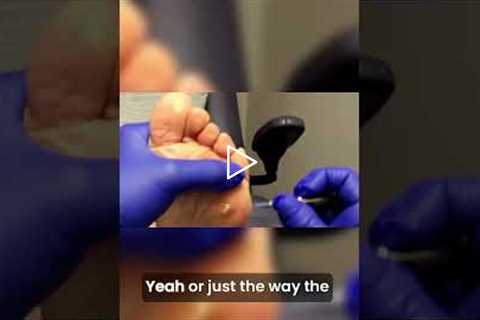 🎥 Removing Keratotic Horn | A Step-by-Step Procedure