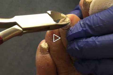 Really Thick Toenails