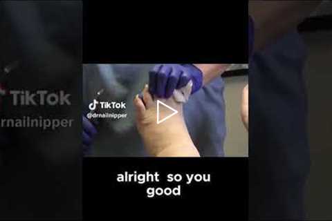 Why You Shouldn't Skip Your Toenail Appointments, Severely Overgrown Nails Finally Trimmed #nailcare