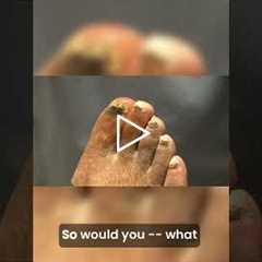 Is Your Nail Fungus Getting Worse? 😱 #healthcare #pedicure