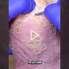 Deep Corn Extraction: Why You Shouldn't Do This At Home #FootHealth #Satisfying