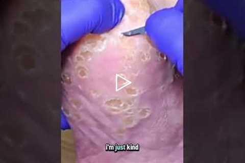 Deep Corn Extraction: Why You Shouldn't Do This At Home #FootHealth #Satisfying
