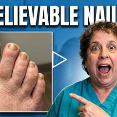 Severe Leg Swelling, Lymphedema & Toenail Care | What Really Helps?