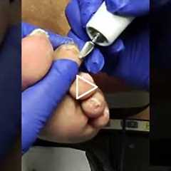 The Most Satisfying Part of a Foot Exam