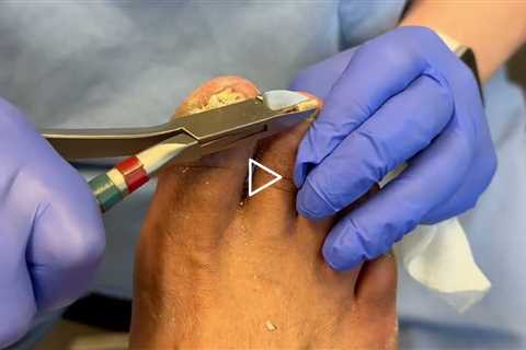 Ganglion Cyst Drainage and Foot Care Explained -- Highlight