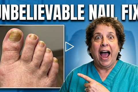 Severe Leg Swelling, Lymphedema & Toenail Care | What Really Helps?