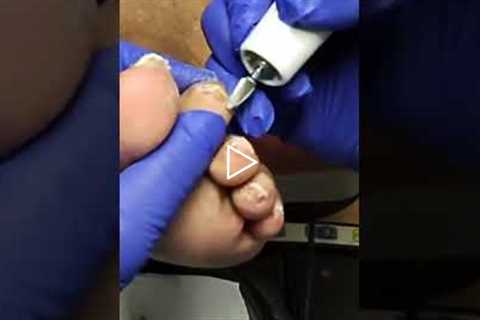 The Most Satisfying Part of a Foot Exam