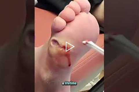 Cleaning This Infected Foot Will Shock You #asmr #medical