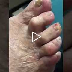 The Final Step Applying Antibiotic Cream