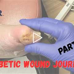 FEET-ure Friday |  She Thought It Was Just Cracked Skin... It Was a Diabetic Foot Wound 😳🦶 - Part ..