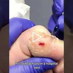 The doctor strongly recommends using a knee scooter to keep pressure off the wound