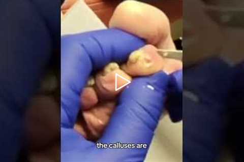 Tackling tough calluses, Pumice Stone