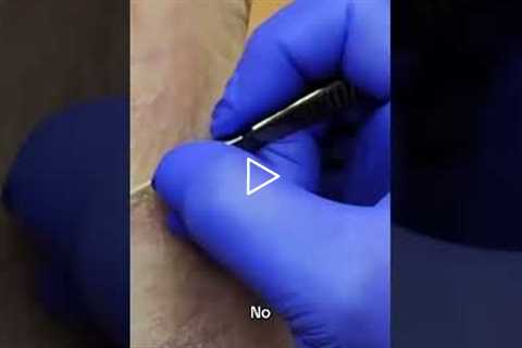 This podiatrist removes calluses while talking about boring summers #satisfying #podiatrist