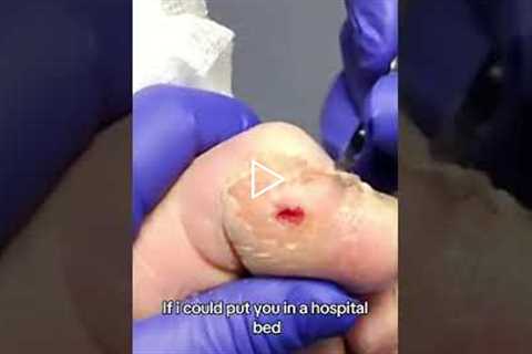 The doctor strongly recommends using a knee scooter to keep pressure off the wound